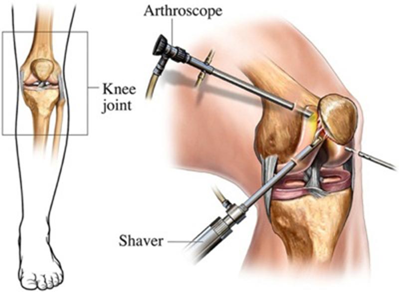 Rotator Cuff Tear