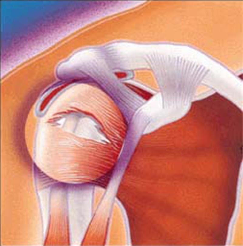 Rotator Cuff Tear