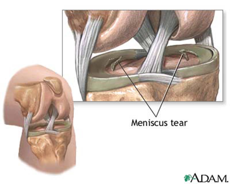 meniscus tear